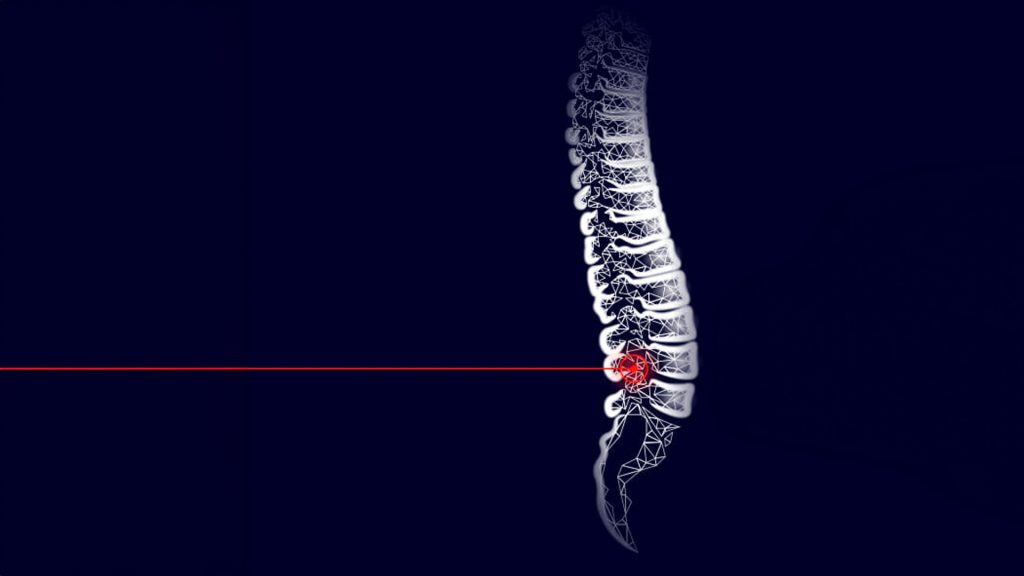 นวัตกรรมการรักษาหมอนรองกระดูกสันหลังทับเส้นประสาทด้วยเลเซอร์ (LASER) แสดงภาพจำลองกระดูกสันหลังโดยเน้นจุดที่มีการกดทับ ลดอาการปวดหลังด้วยเทคโนโลยีขั้นสูง